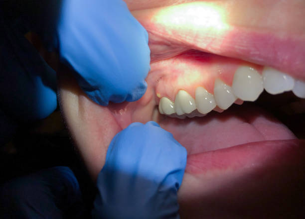 Best Emergency Dental Care for Broken or Chipped Teeth in Brookfield, WI